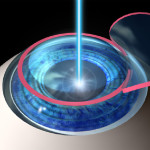 Does Insurance Cover LASIK?
